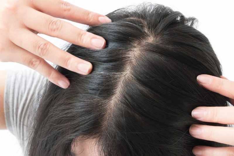 sampon protiv opadanja kose difuzno opadanje