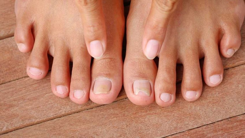 Scholl Fungal nail tretman za nokte