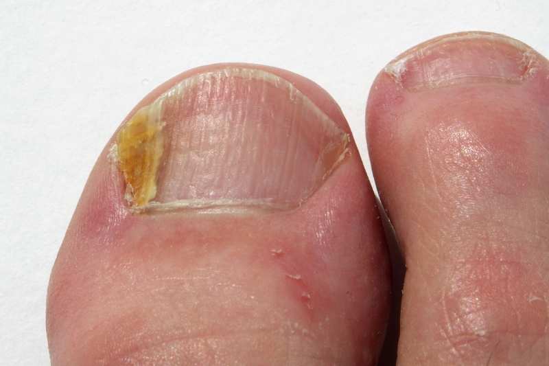blaza gljivicna infekcija nokta