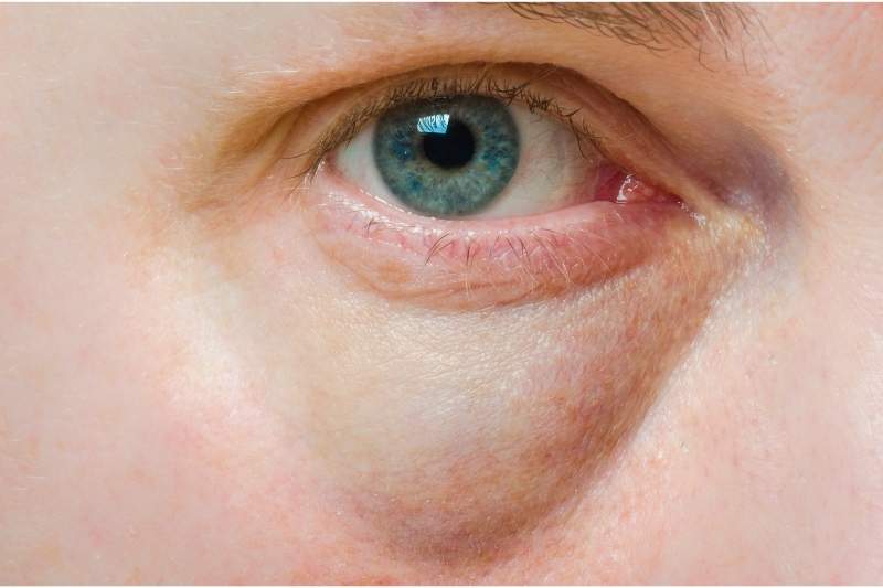 Eucerin Aquaporin krema oko ociju za otecenost i podocnjake