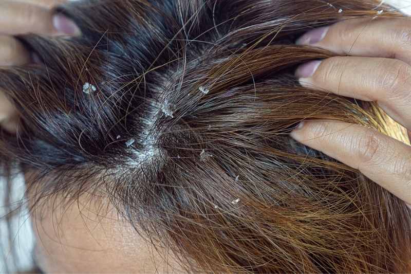 Allin sampon za seboreju za masnu kosu i seboroicni dermatitis
