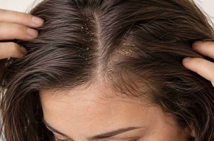  Seboreični dermatitis: kad perut nije samo perut!